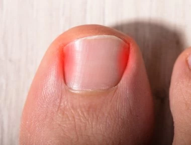 Τι να κάνετε για ένα νύχι που μπαίνει στο δέρμα – Θεραπεία και πρόληψη